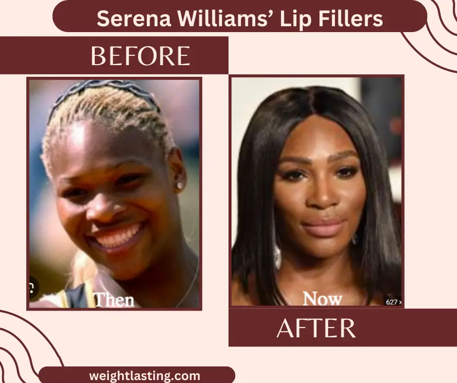 did serena williams have plastic surgery