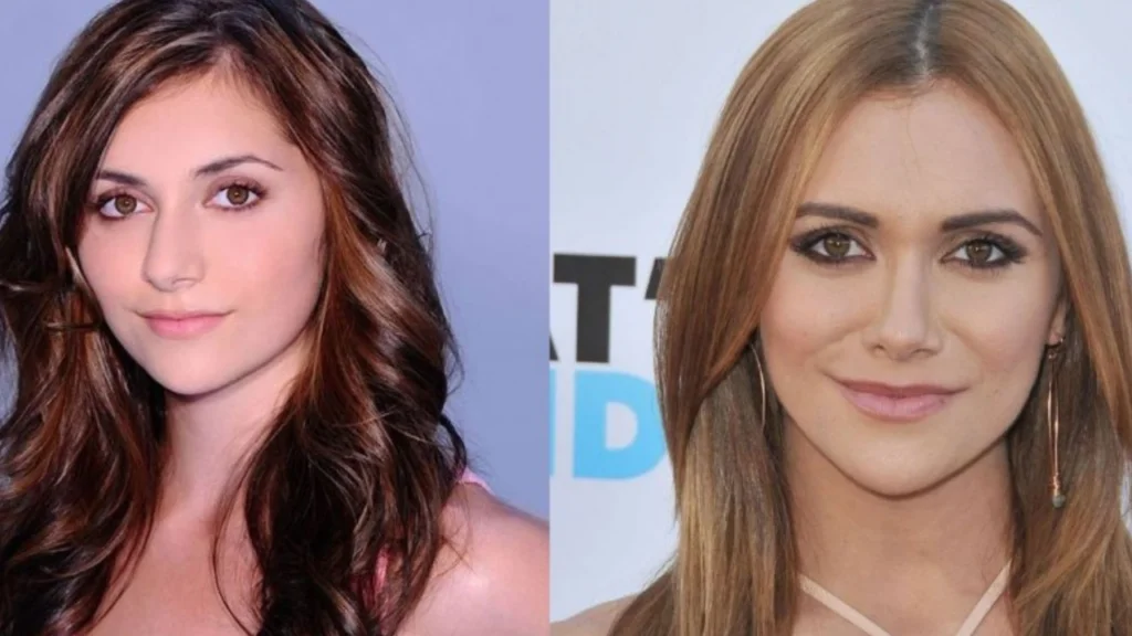 Alyson Stoner Plastic Surgery