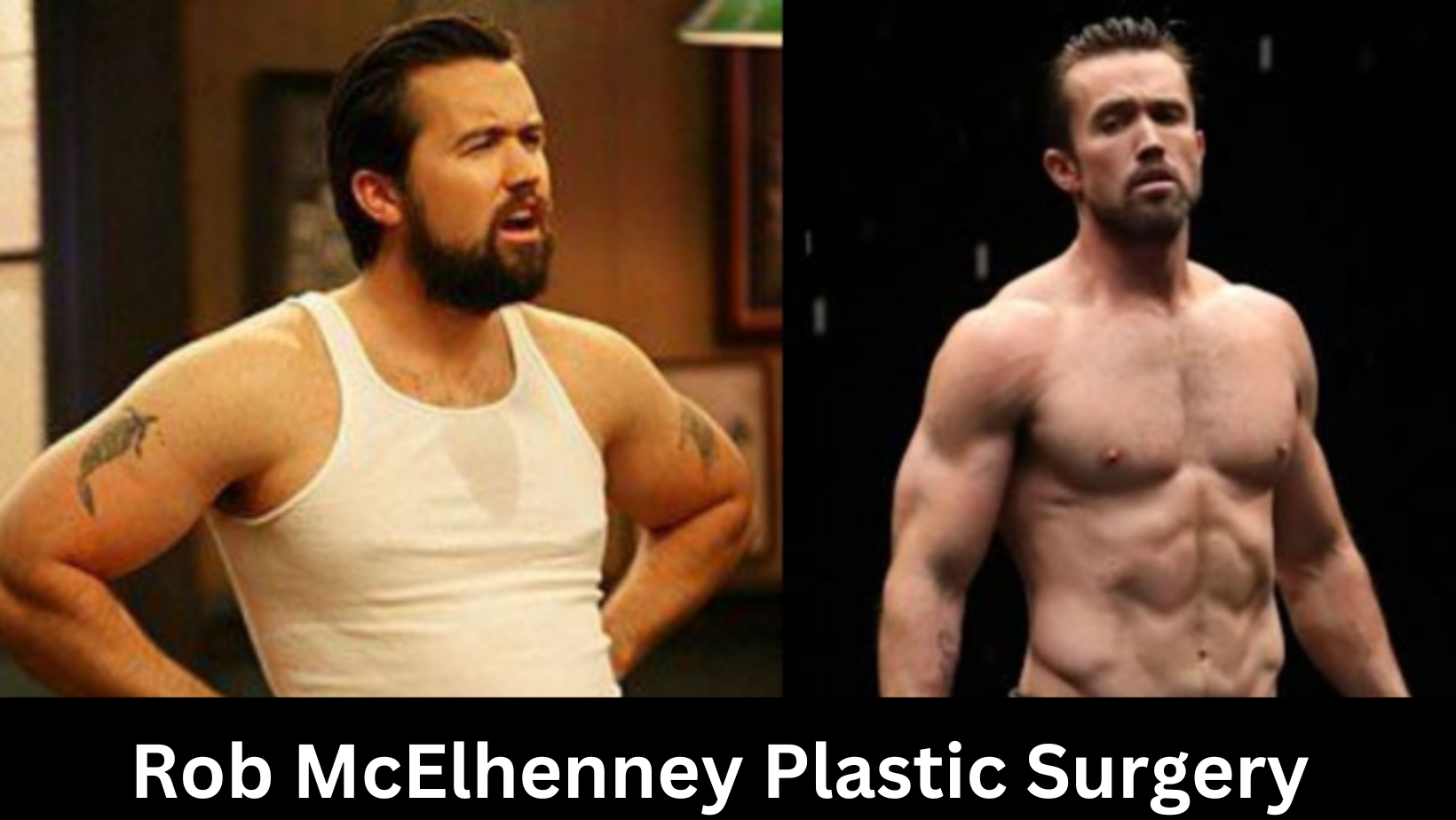 Rob McElhenney Plastic Surgery