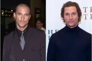 Matthew Mcconaughey plastic surgery